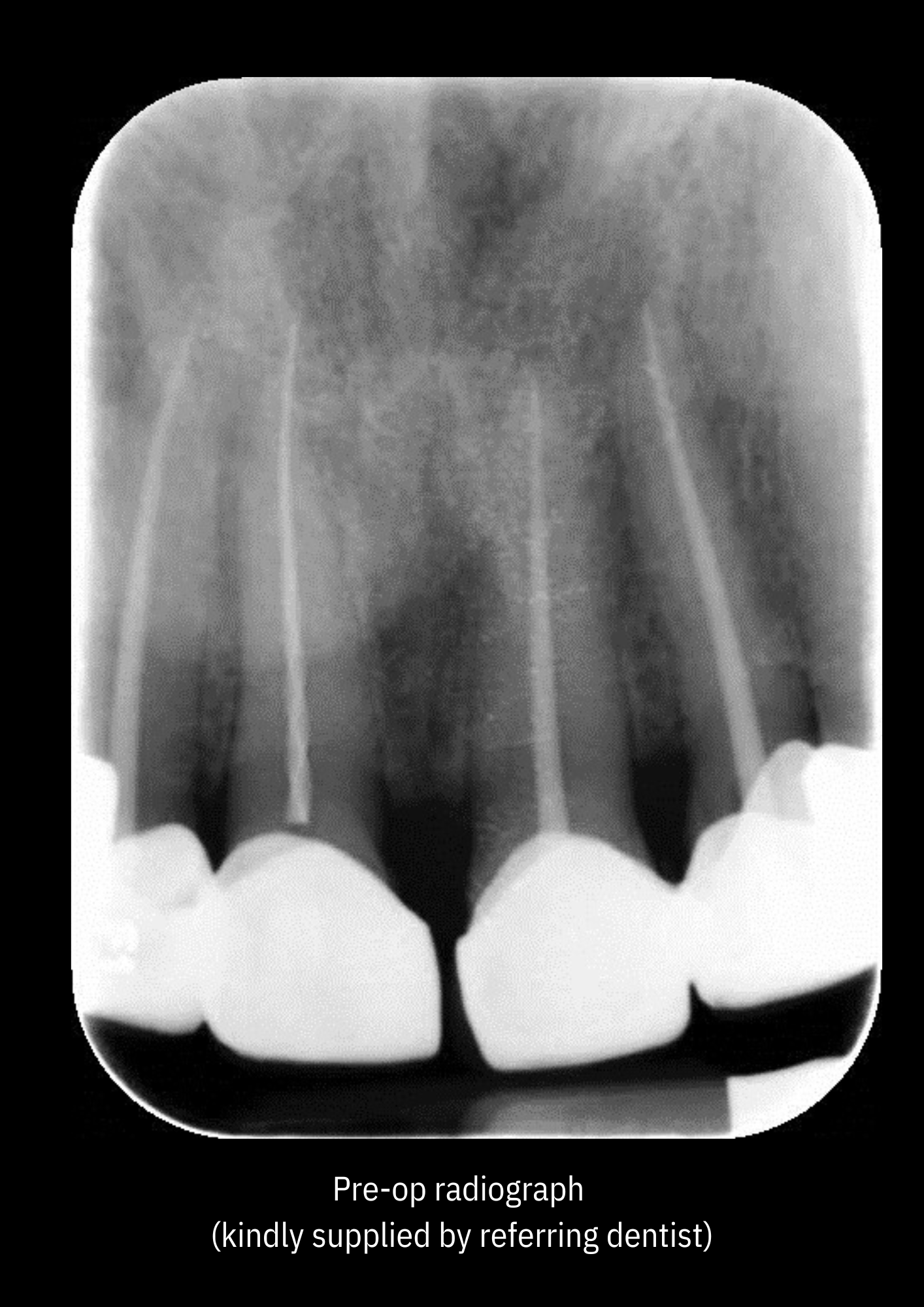 A broken instrument – my story – Endo Elements